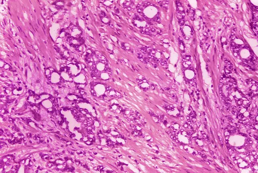 This 1974 microscope image made available by the Centers for Disease Control and Prevention shows changes in cells indicative of adenocarcinoma of the prostate. A study published by the New England Journal of Medicine on Saturday, March 11, 2023, finds long-term evidence that actively monitoring prostate cancer can be a safe alternative to immediate surgery or radiation. (Dr. Edwin P. Ewing, Jr./CDC via AP)